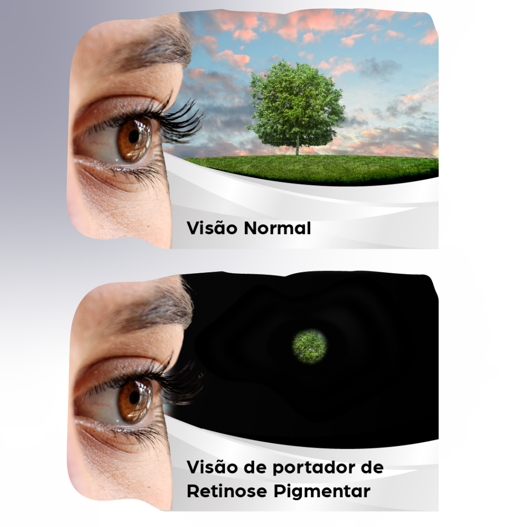 Veja como funciona a retinose pigmentar